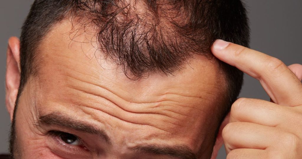 Quais os Tipos de Alopecia Dr Paulo Müller